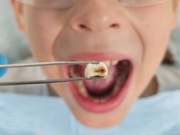 Best Emergency Gum Treatment in Eagle, CO